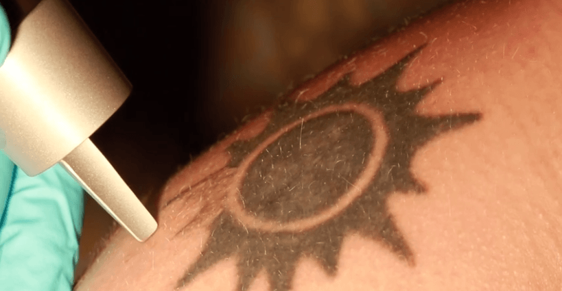 Removiendo un tatuaje con laser